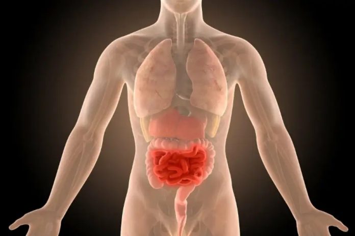 Νόσος του Crohn, εικαστικό