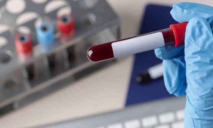 Surgeon holding a blood test blood transfusion